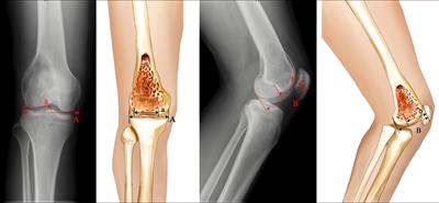 Clinical evaluation of the three-dimensional printed strut-type prosthesis combined with autograft reconstruction for giant cell tumor of the distal femur
